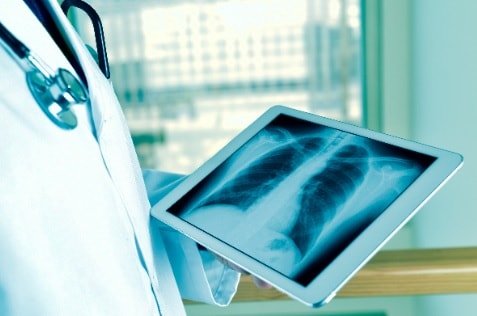 tuberculose