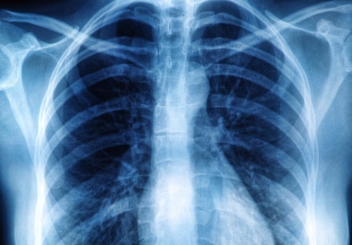 fibrose pulmonar