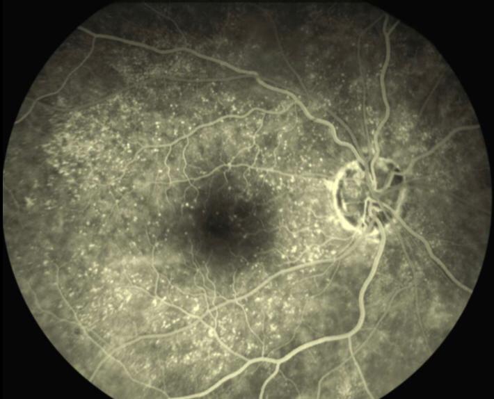 Degeneração Macular Relacionada à Idade