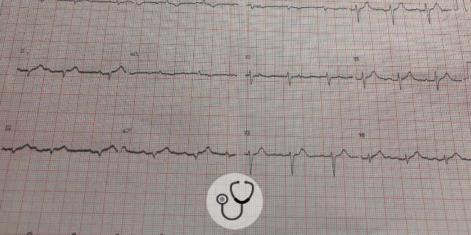 Cardiomiopatia de takotsubo