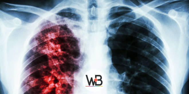 hemoptise