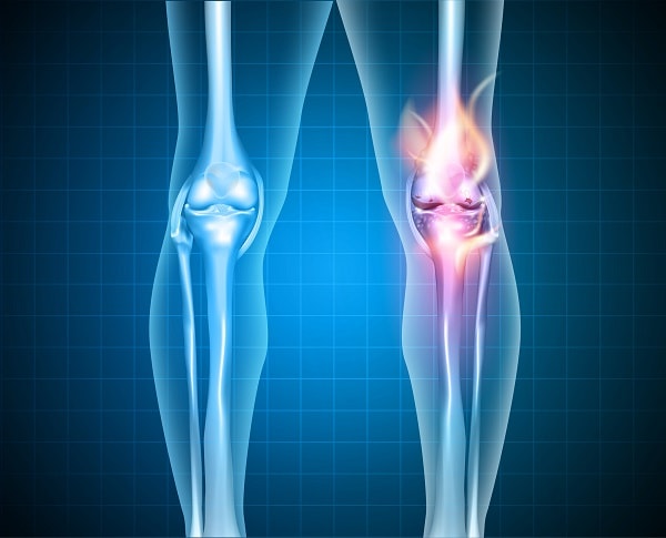 osteoartrite de joelho