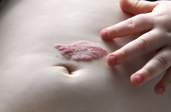 hemangioma
