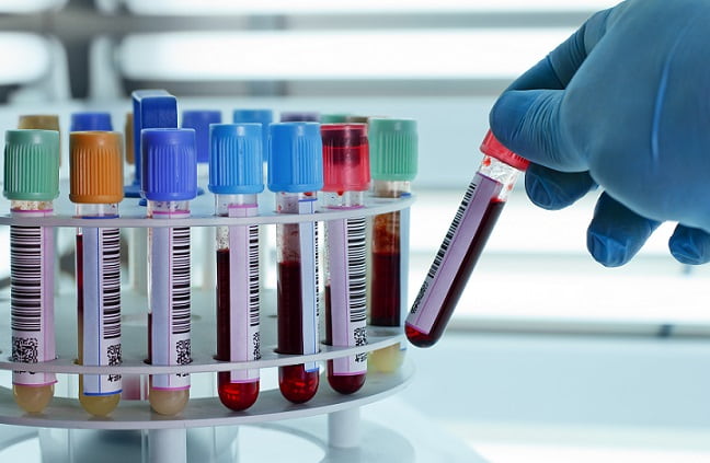 vidros de sangue colhidos para análise prognóstica de linfoma folicular