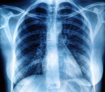 O pneumotórax, com elevada incidência na população, tem como quesito de maior relevância no seu manejo a prevenção de recorrências.