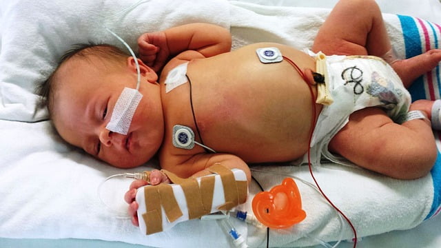Prevalência e mortalidade por pneumotórax de acordo com idade gestacional em recém-nascidos
