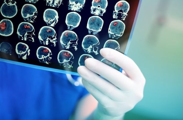Avaliação clínica, neuroimagem e tap test orientam decisões sobre o tratamento da hidrocefalia de pressão normal idiopática