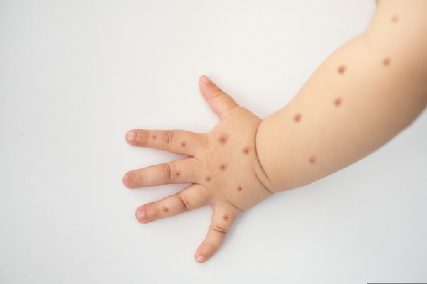 monkeypox em bebês