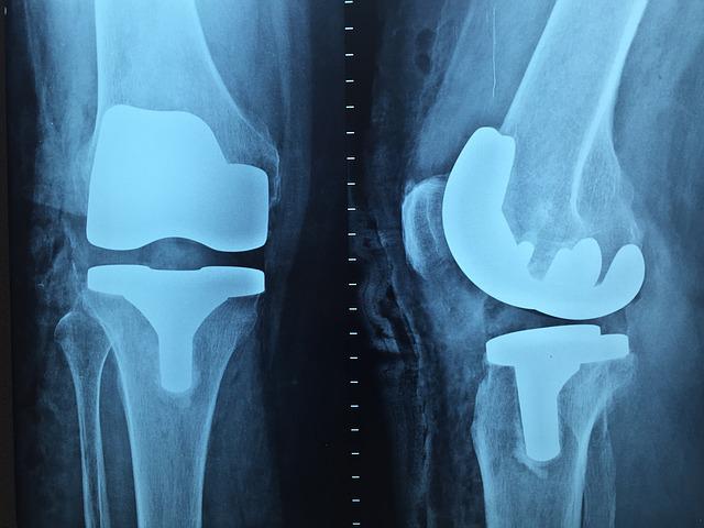 Qual tratamento previne mais contra tromboembolismo venoso após artroplastia total de joelho ou quadril?