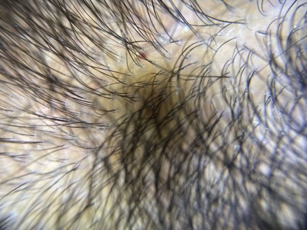 Paciente do sexo feminino, 50 anos, saudável, relata perda de cabelo progressiva nos últimos dois anos, com necessidade do uso de apliques de cabelo, além de sensibilidade e ardência no couro cabeludo. Também perceber rarefação leve da cauda das sobrancelhas. O exame físico chamou a atenção pela rarefação capilar importante no vértice e laterais do couro cabeludo. Com o dermatoscópio foi possível visualizar eritema e escamas ao redor dos folículos.