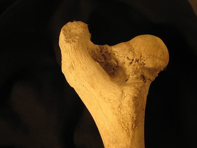 Quais são os resultados após dez anos de tratamento do impacto femoroacetabular