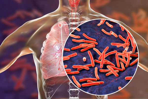 Teste de tuberculose para pessoas com quadro grave de HIV/Aids