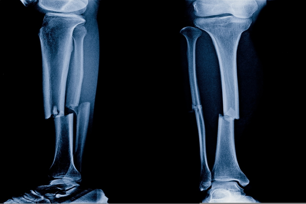 O uso de bifosfonatos prejudica a consolidação de fraturas de ossos longos?