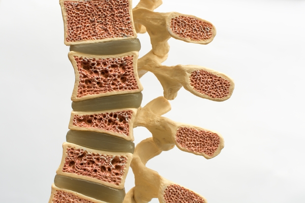 Novas recomendações ACR para prevenção e tratamento da osteoporose induzida pelos glicocorticoides