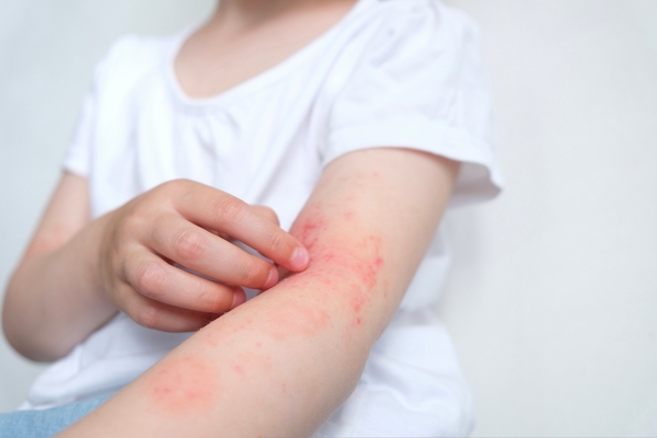 Dermatite atópica tem relação com uso de emolientes no primeiro ano de vida?