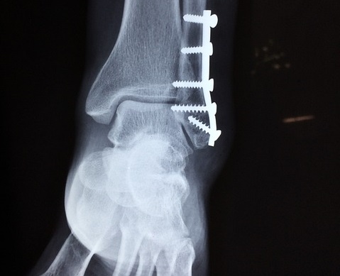 Fatores de risco para infecção após osteossíntese do tornozelo