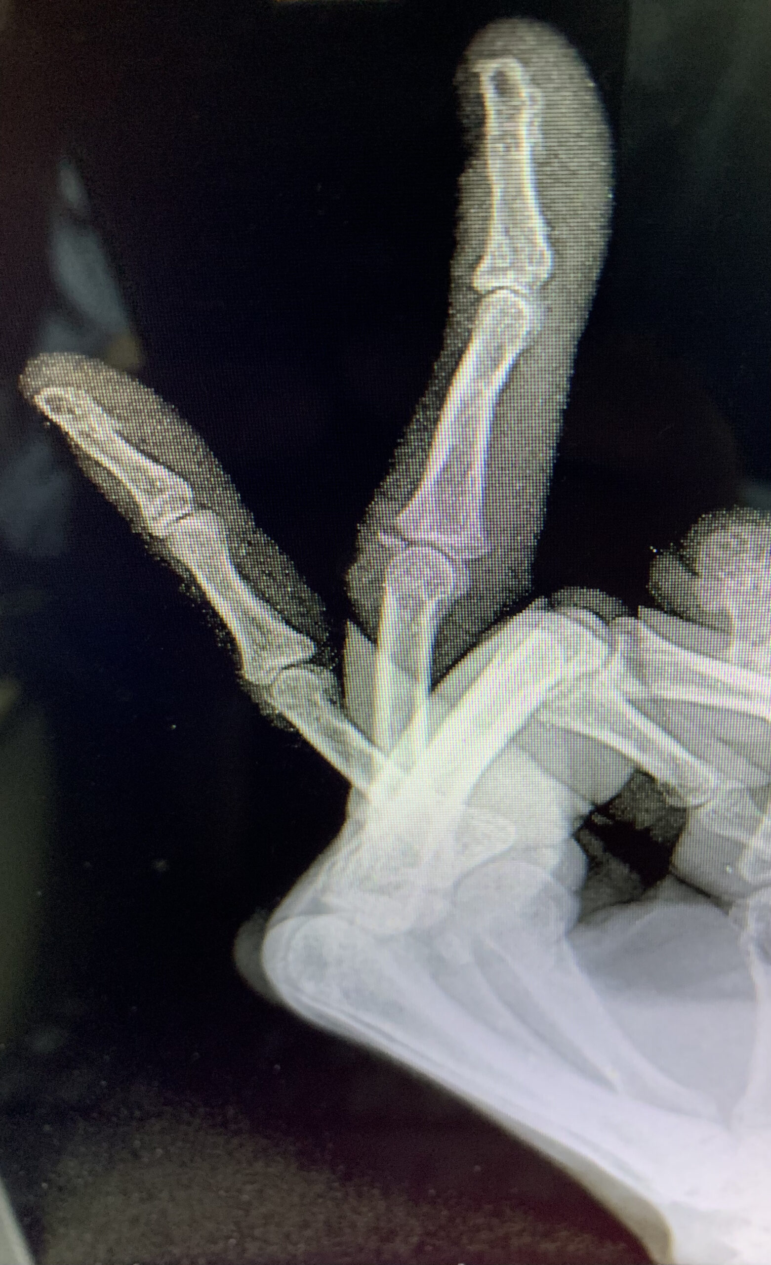 Radiografia de dedo em botoeira