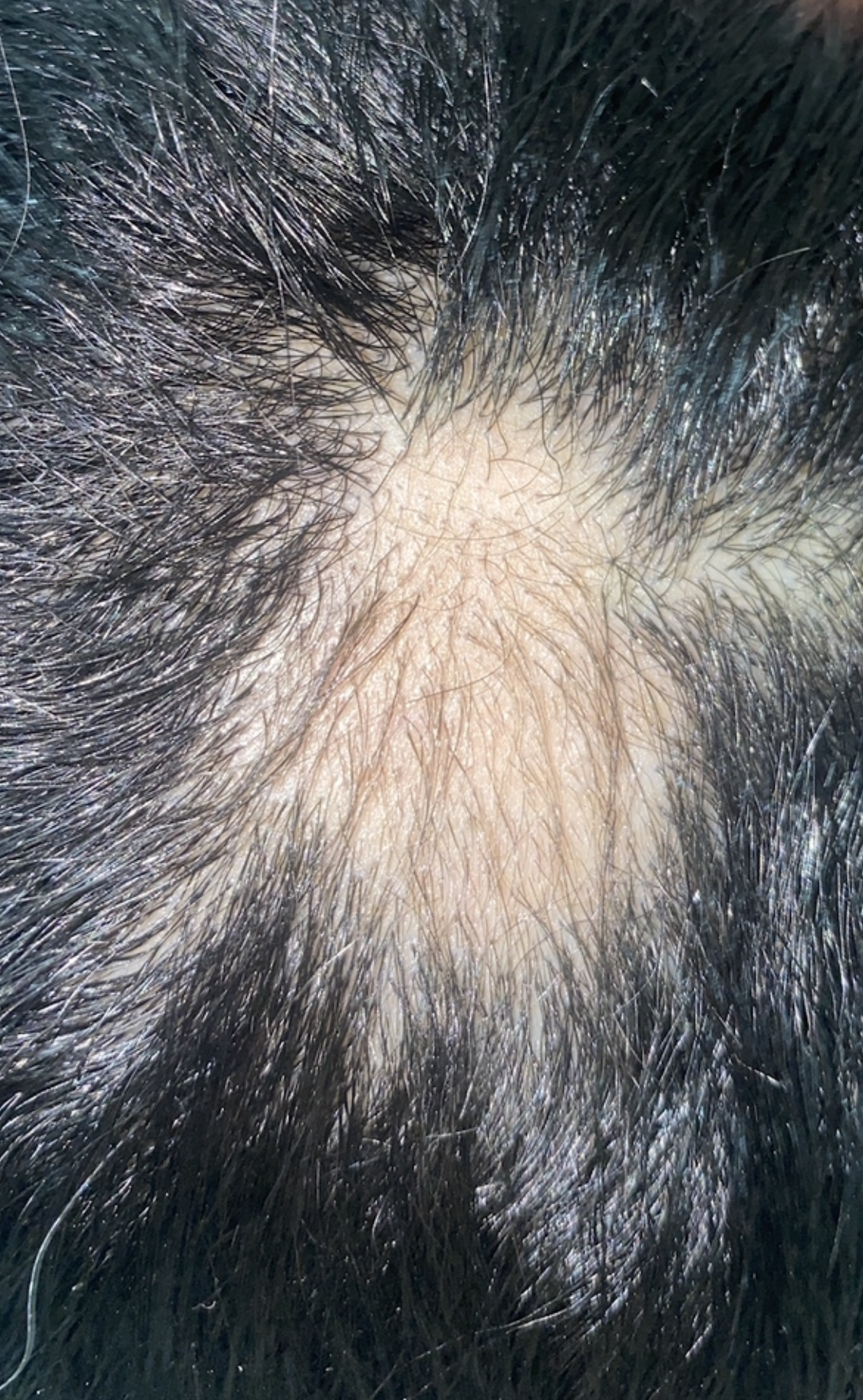 placa de alopecia única