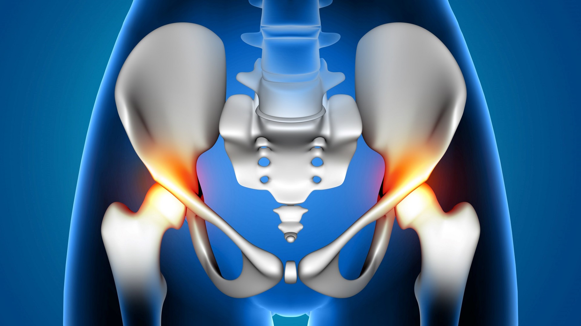 É possível prever necessidade de hemotransfusão antes da artroplastia de quadril? 