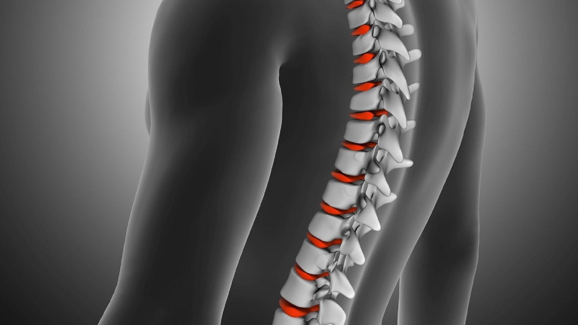 Estudo holandês avalia dor em adolescentes submetidos a cirurgia de escoliose 