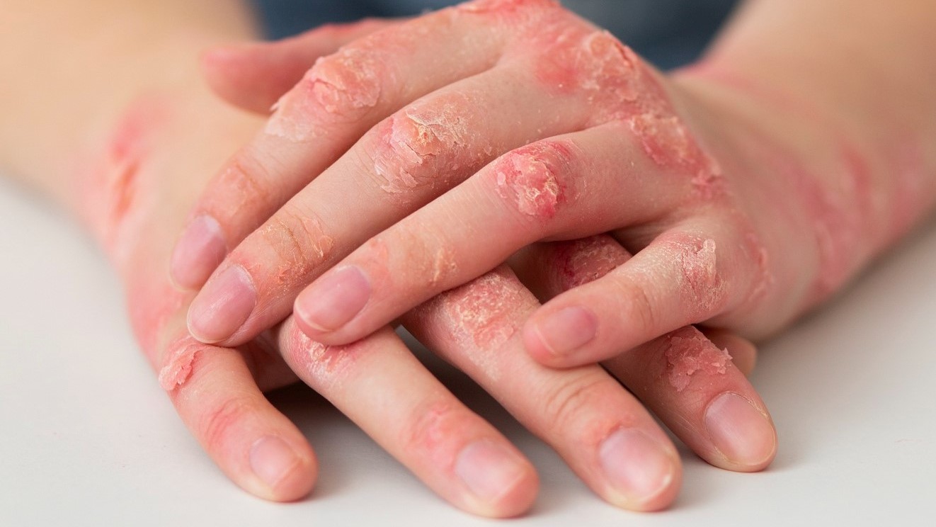 Risco de eczema em paciente com anti-hipertensivos 