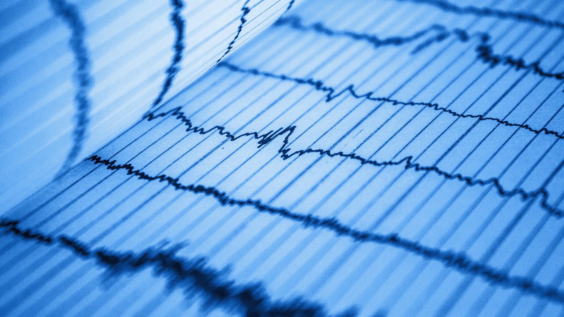 O ECG tem valor diagnóstico para angina vasoespástica e angina microvascular?  