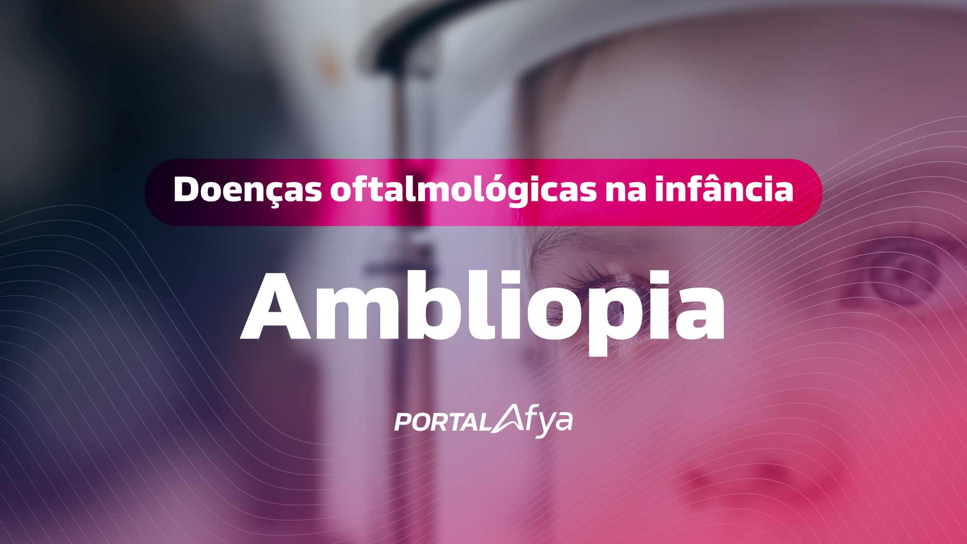 Thumbnail: Principais doenças oftalmológicas na infância: Ambliopia