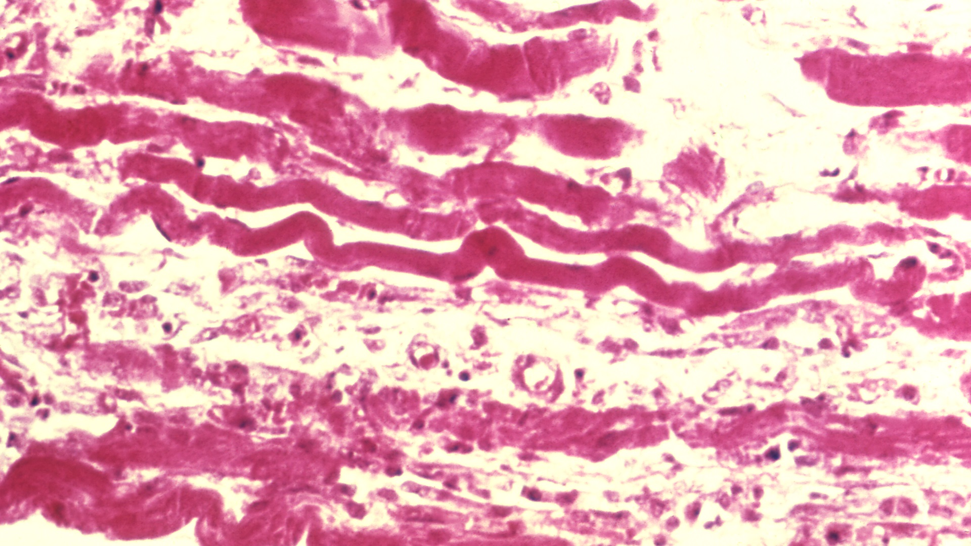 Diagnóstico e manejo de infecções necrotizantes: revisão prática 