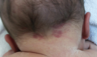 Diferenciando Mancha Salmão e Hemangioma: Compreendendo as Lesões ...
