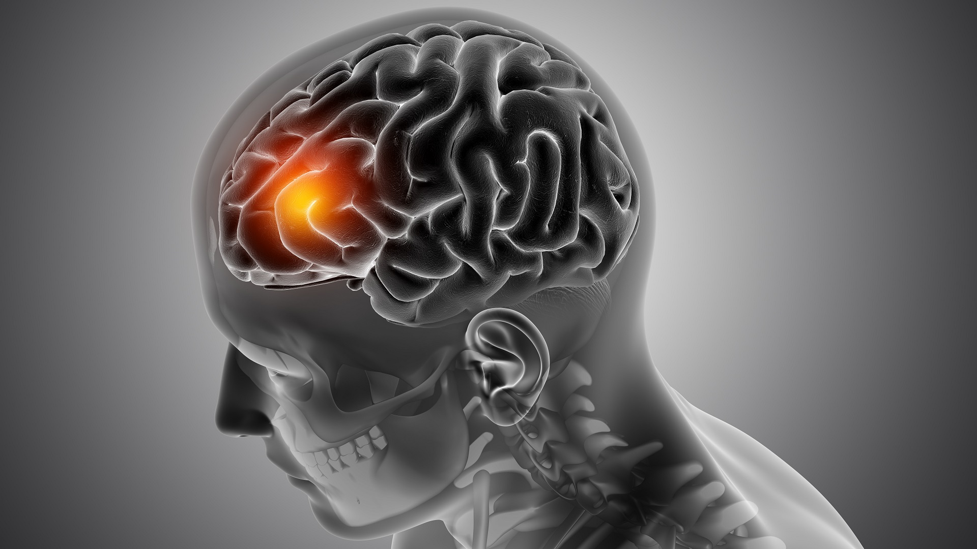 Betabloqueador para pacientes com doença de Huntington 