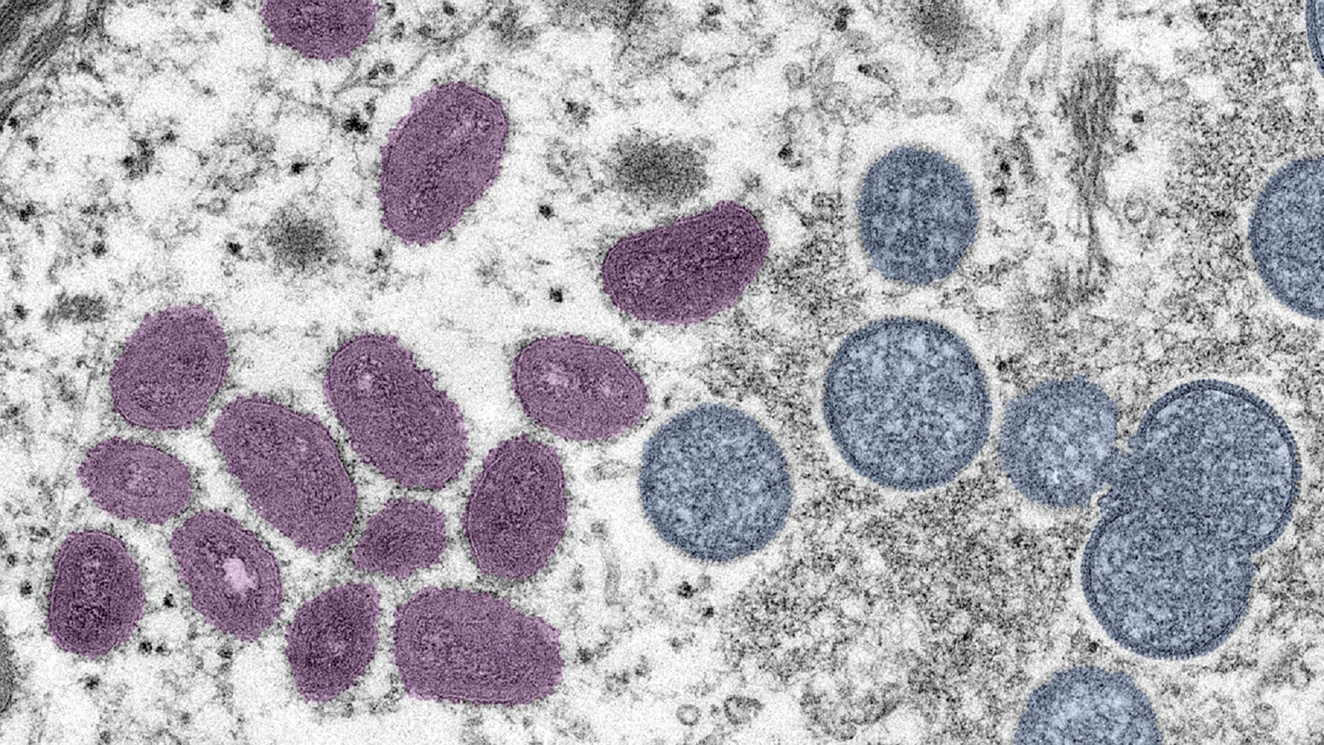 São Paulo confirma primeiro caso no Brasil da nova cepa Ib da mpox