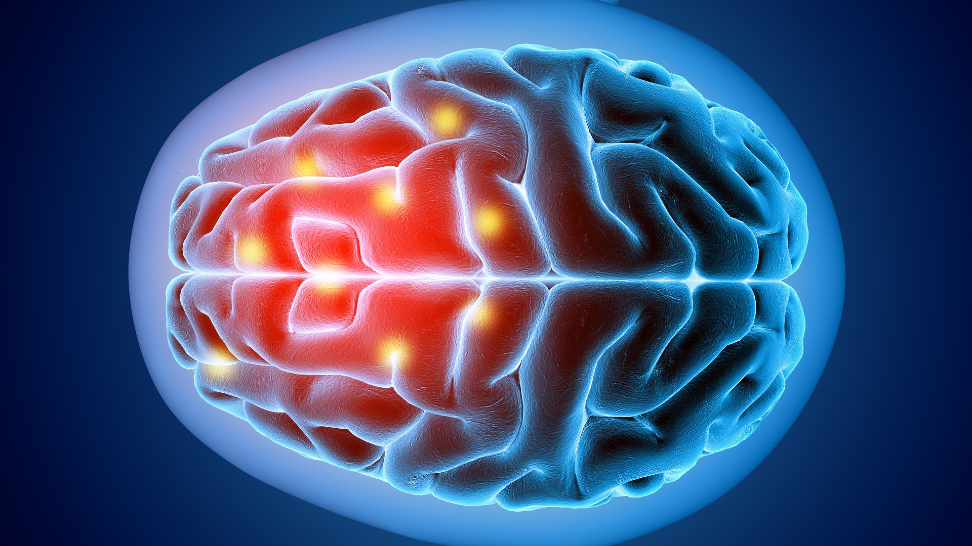 Novas evidências sobre uso de DOAC na trombose venosa cerebral 