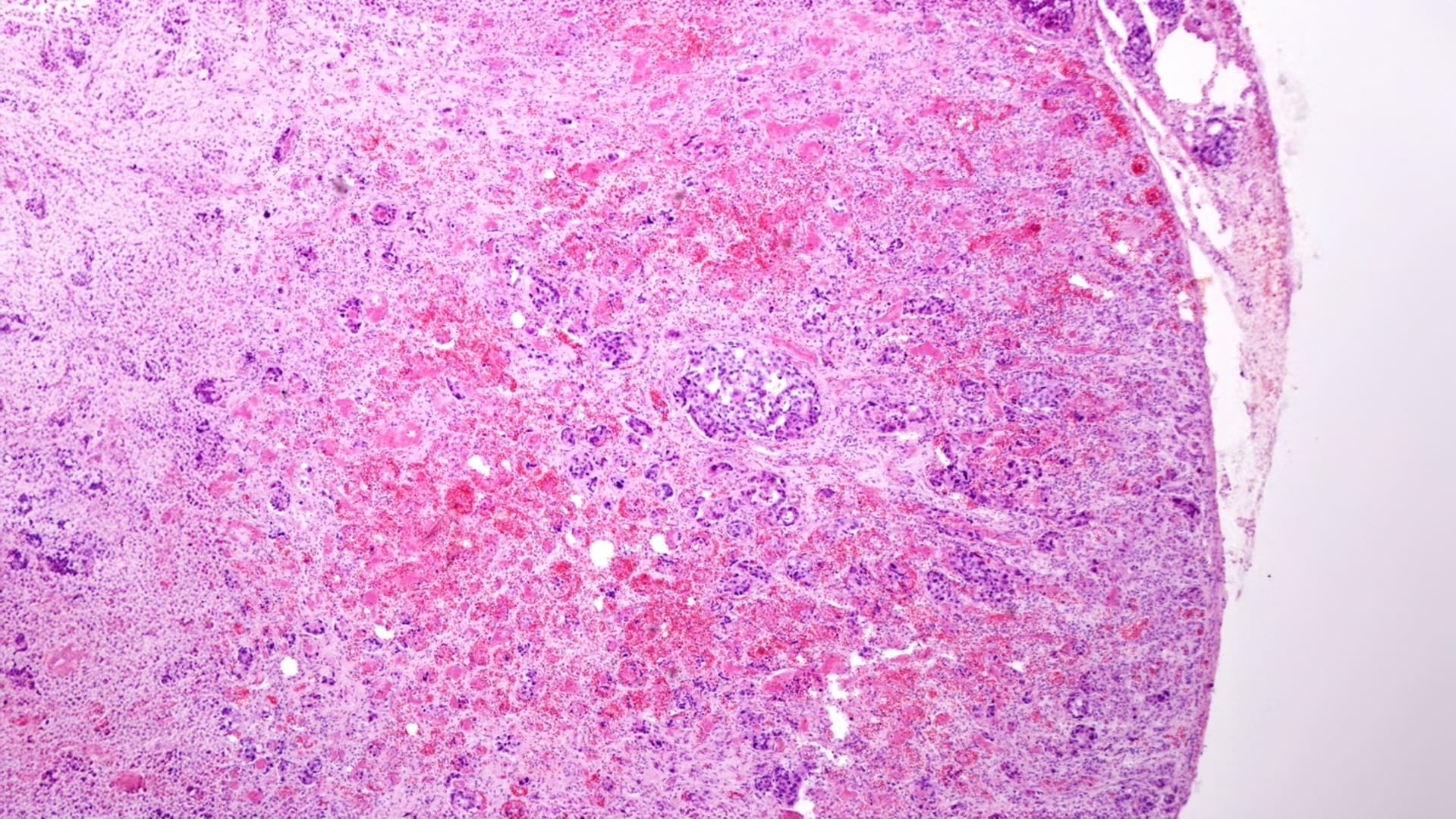 carcinoma