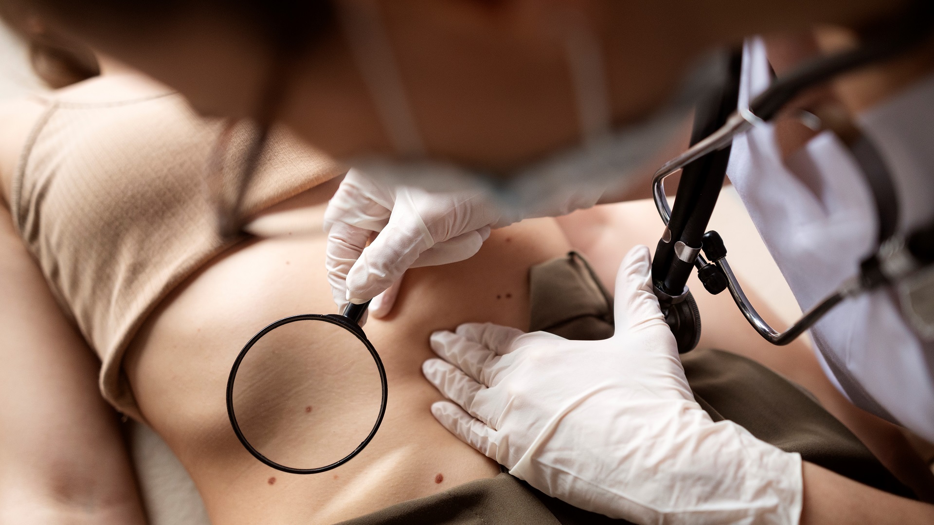 Nevo de Reed e nevo de Spitz: definição, dermatoscopia e manejo 