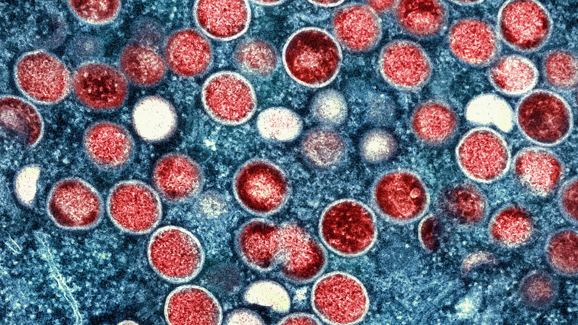 Mpox: A necessidade de uma terapia eficaz 