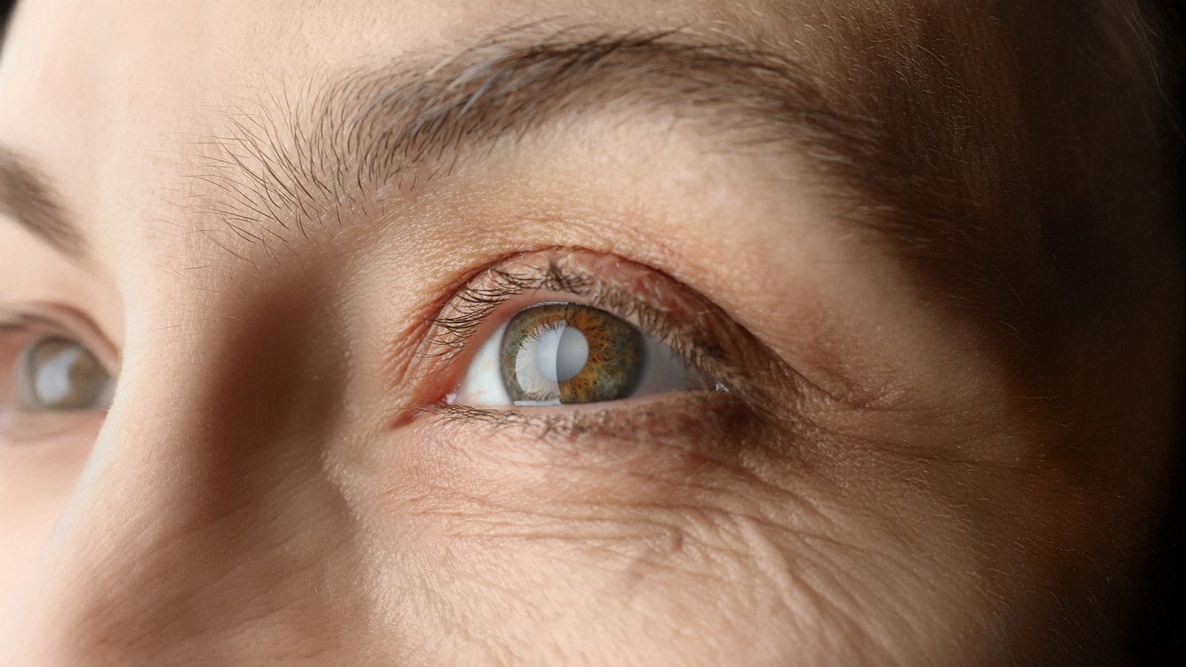 glaucoma