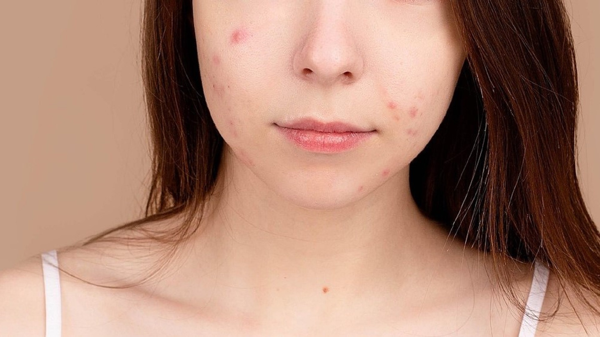 A eficácia e segurança de um novo nutracêutico para acne leve a moderada 