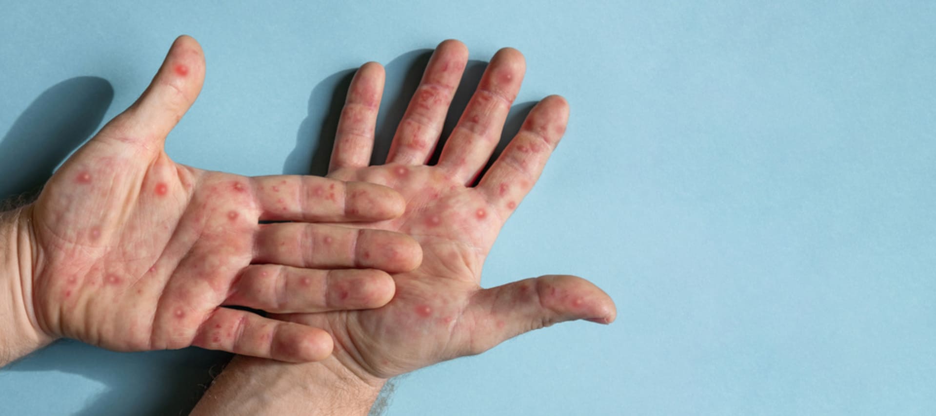 mpox