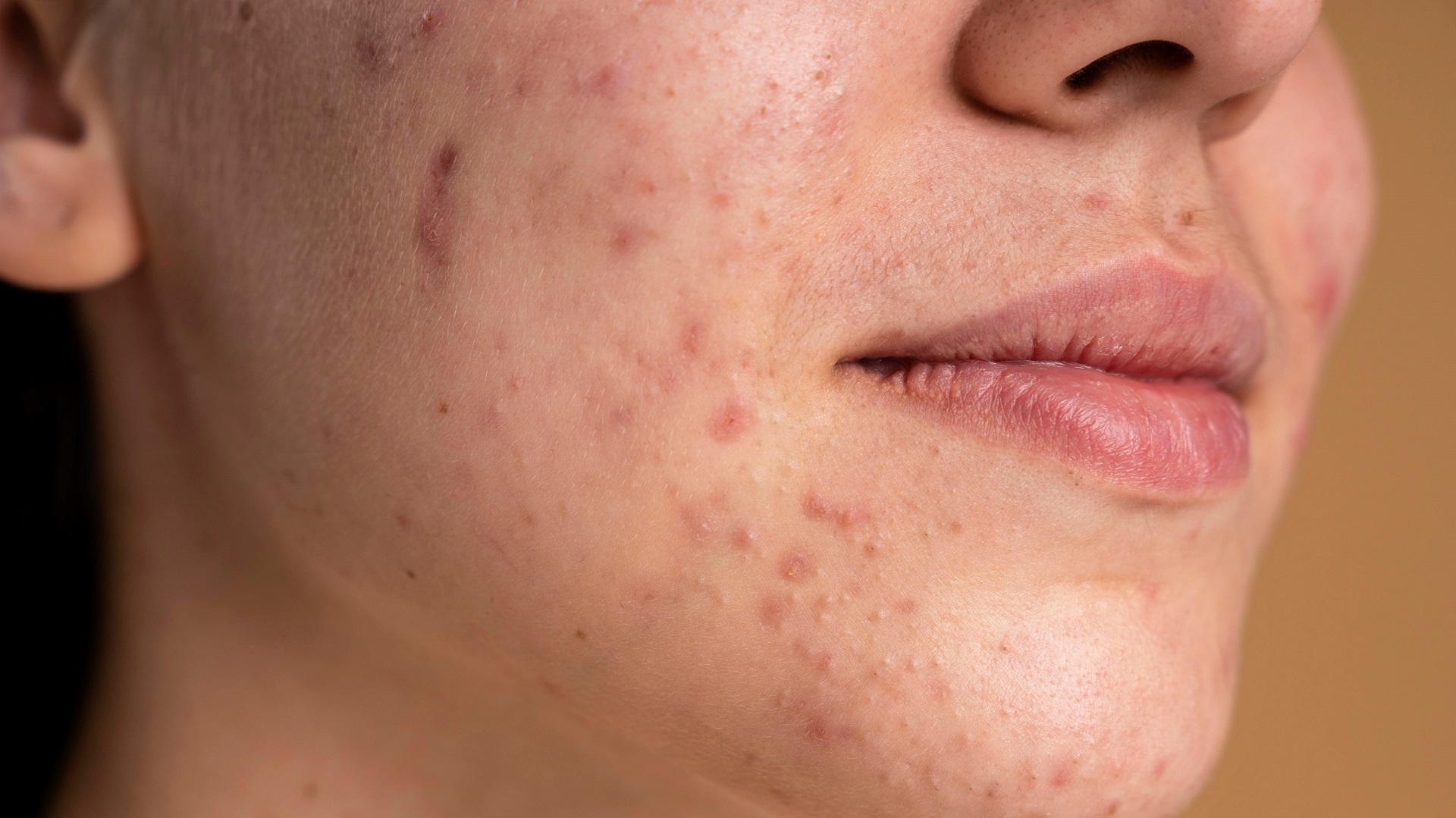 Cicatrizes de acne: protocolo para definir desfechos em ensaios clínicos 
