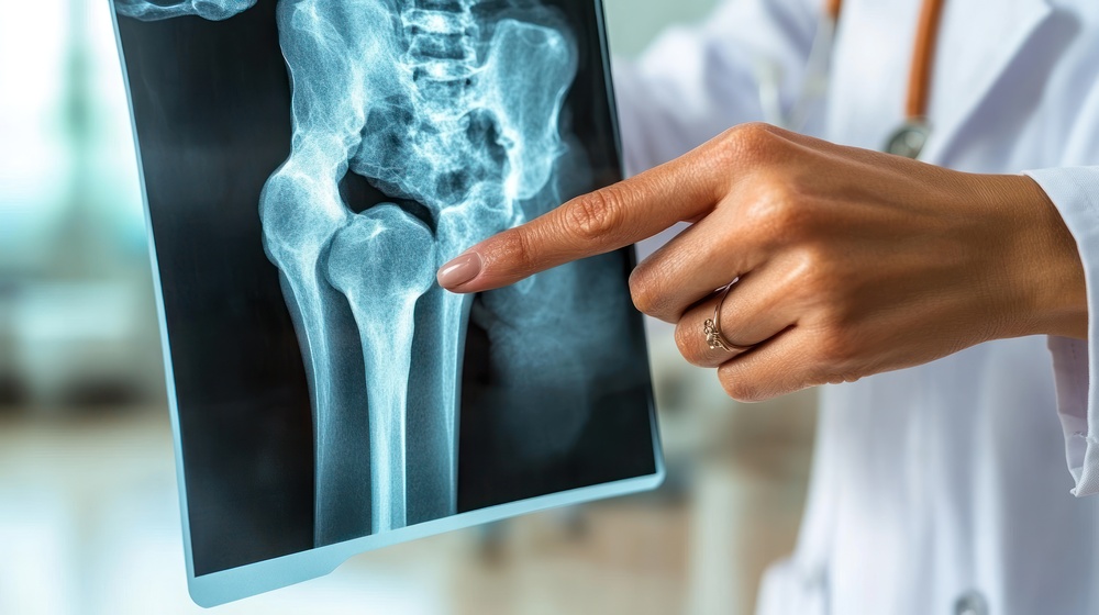 femoroacetabular