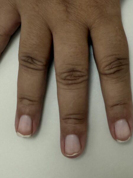 Caso clínico: Unhas da mão com manchas brancas e vermelhas. Qual o diagnóstico?