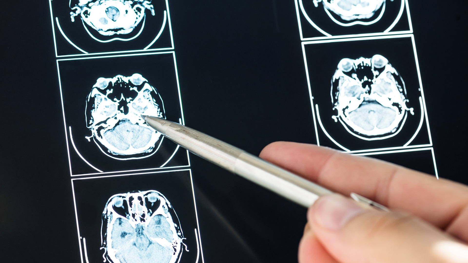 Nimodipina oral vs intraventricular na HSAa: o que dizem as evidências? 