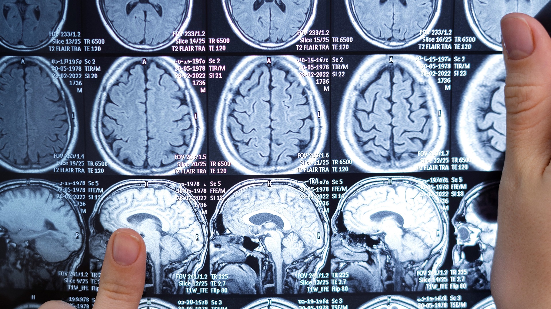 Doença de pequenos vasos cerebrais: Qual o papel das células do sistema imune?  