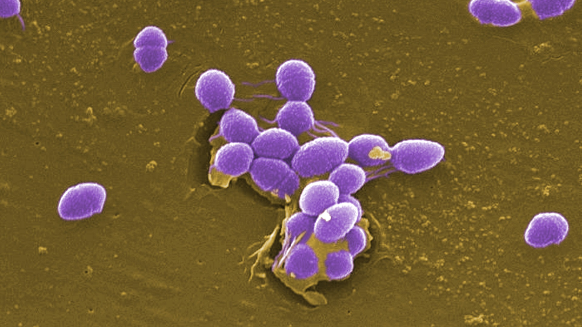 Endocardite infecciosa: Escore de risco em infecções por enterococo 
