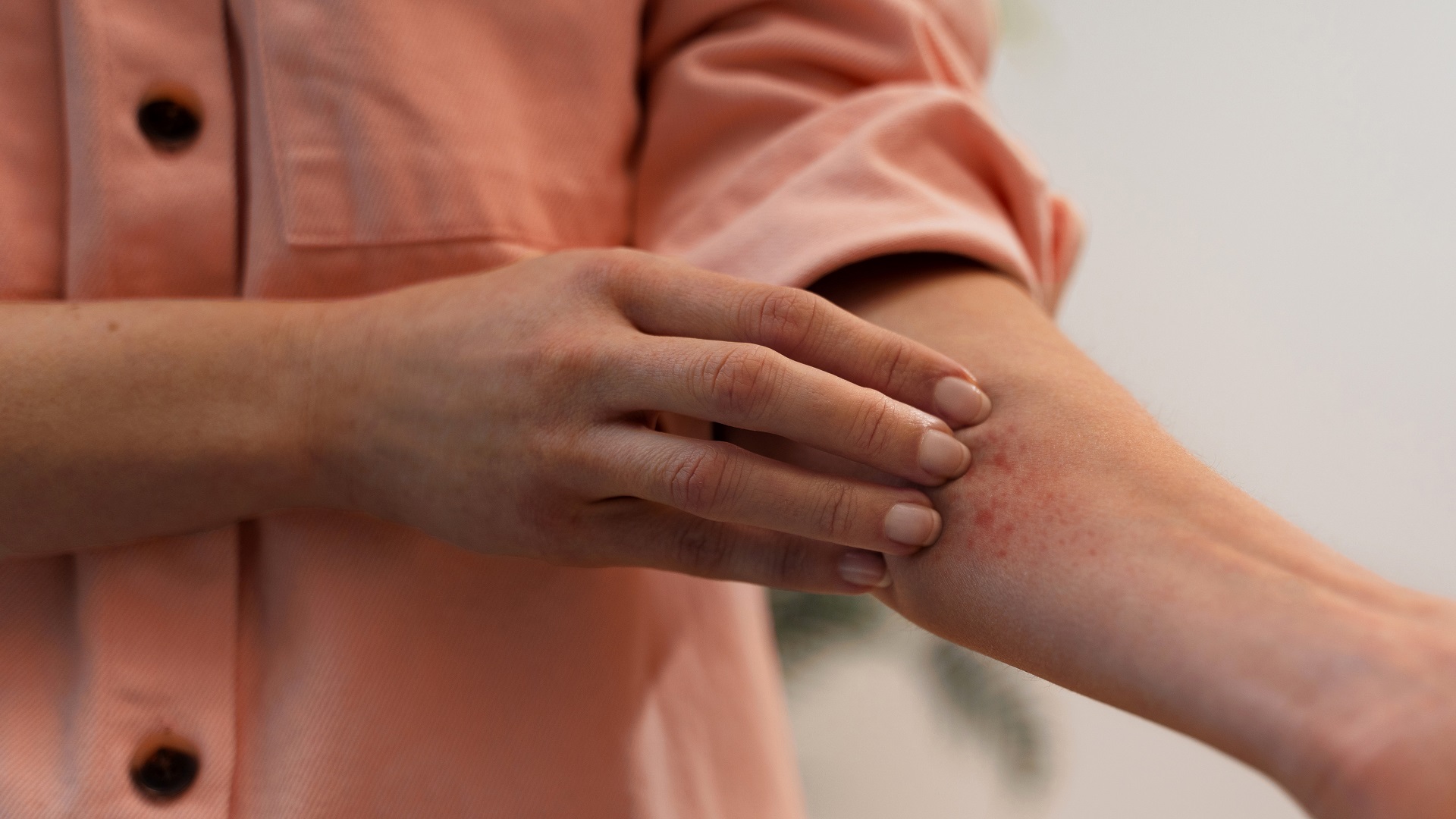 A dermatite atópica está associada a distúrbios metabólicos sistêmicos?  