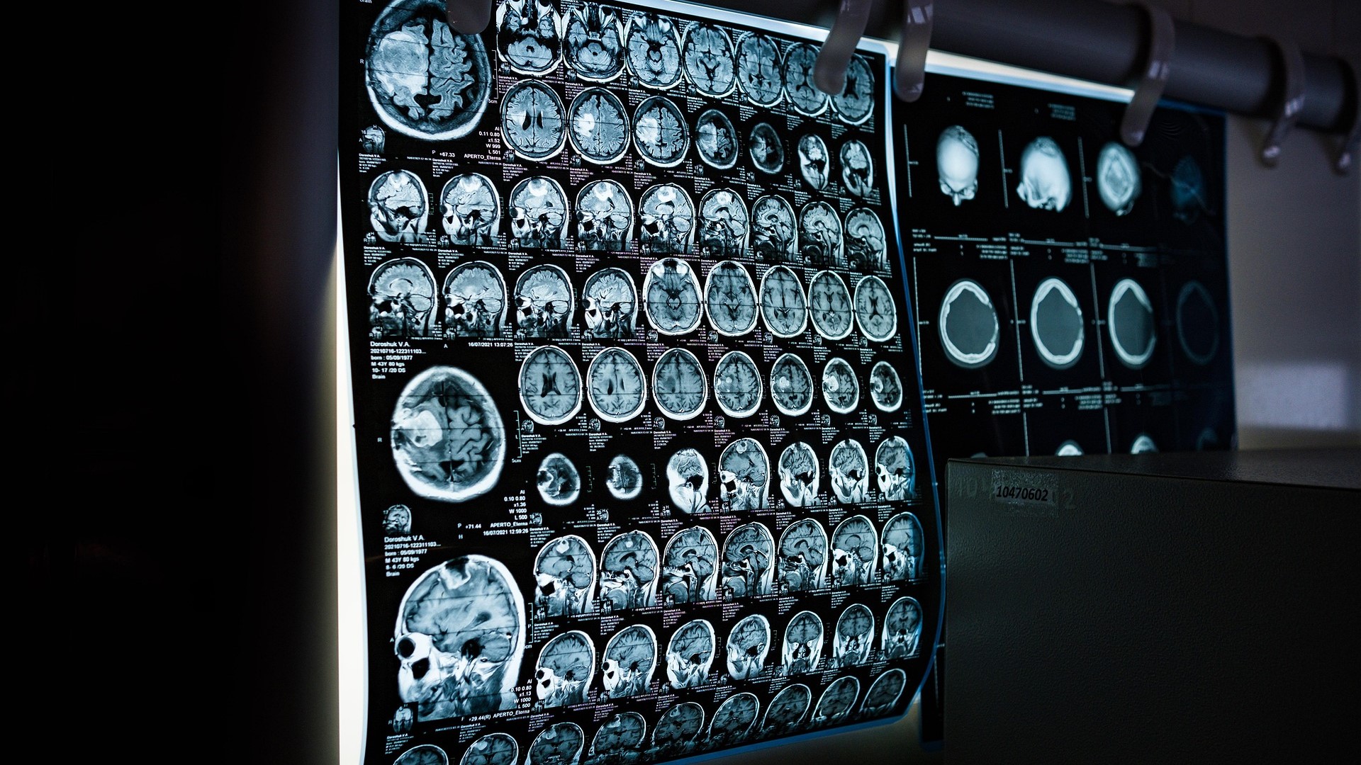 Aneurismas Intracranianos Não Rotos: Como conduzir? 