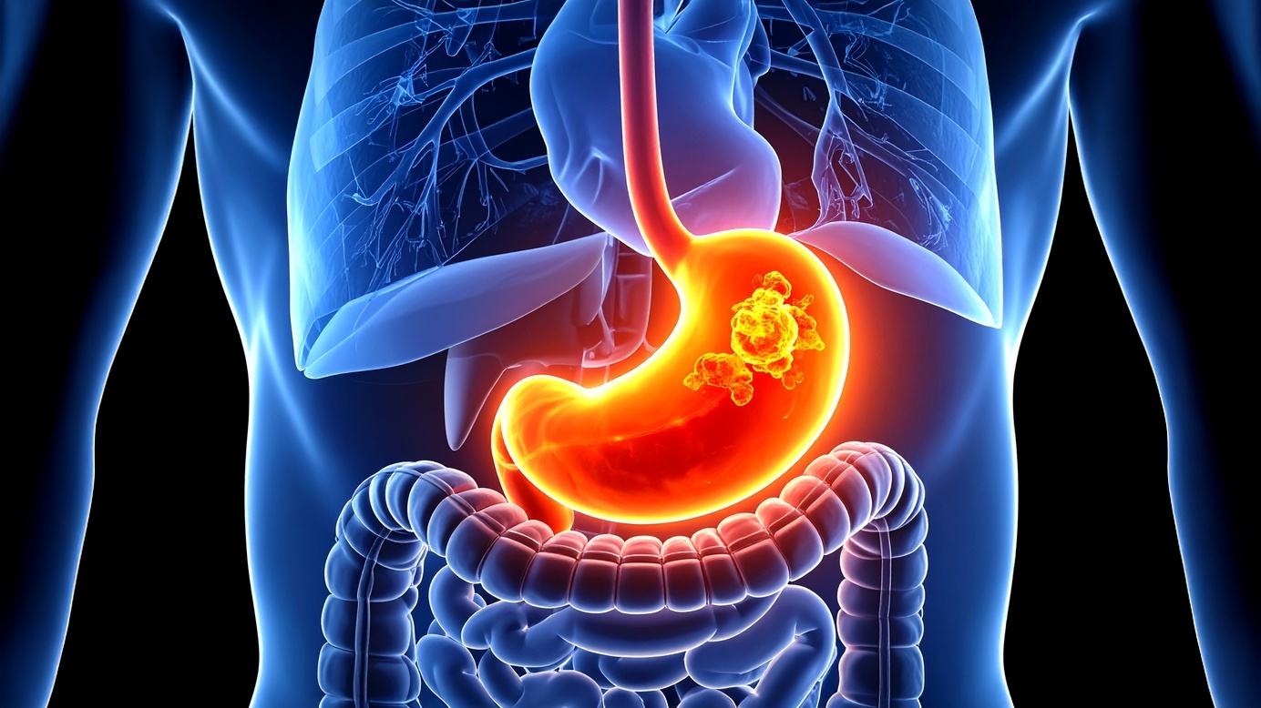 pneumonia pós-gastrectomia