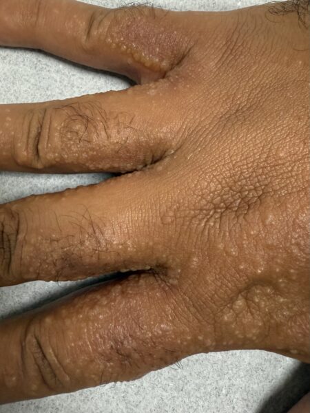 Vesículas no dorso das mãos 