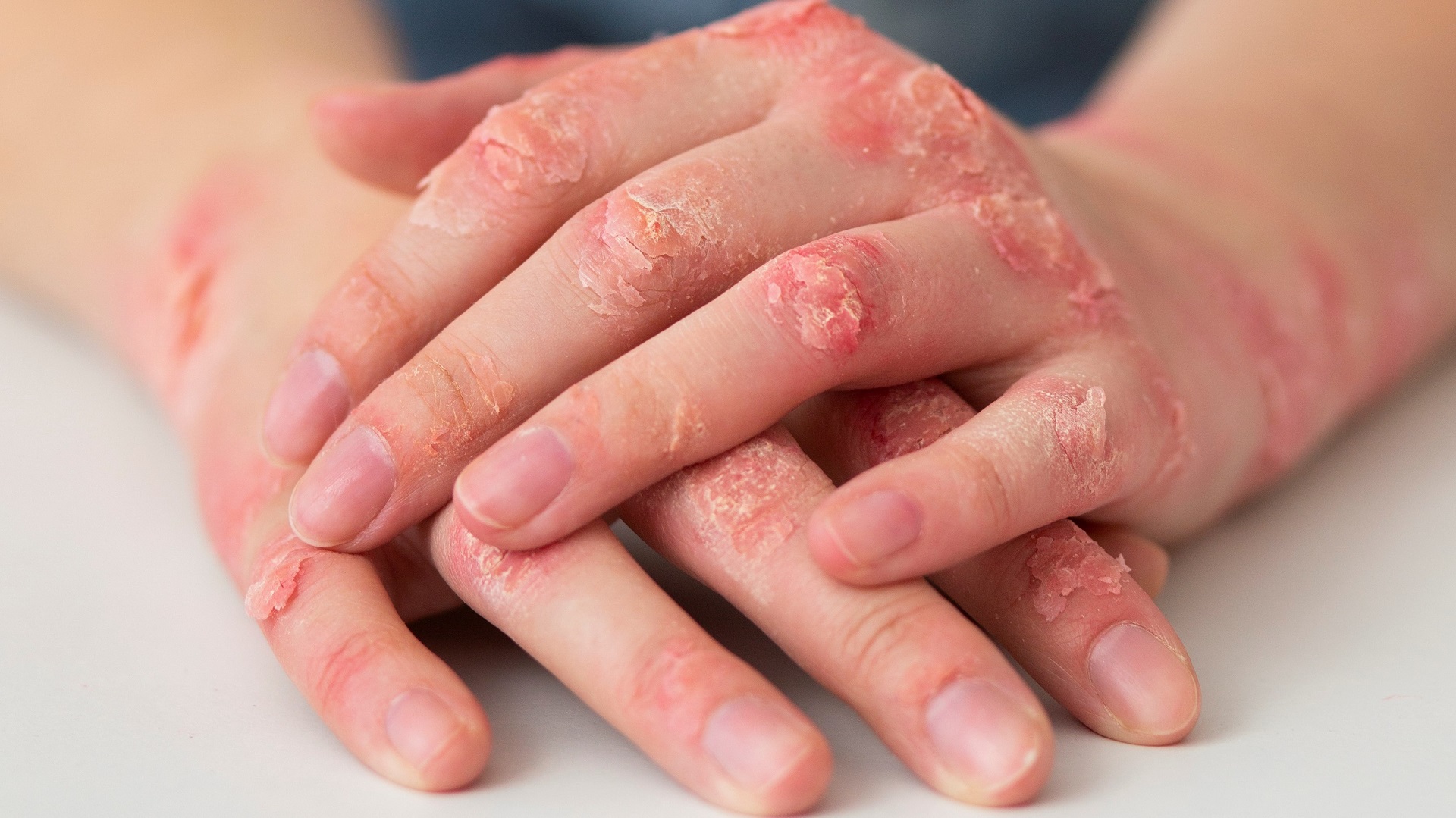 Psoríase: riscos de mortalidade associados à doença 