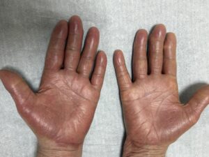 Edema nas palmas das mãos